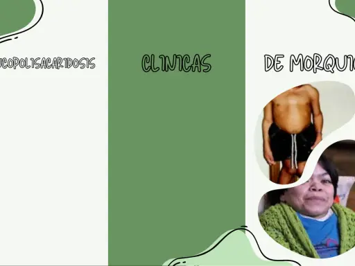 Mucopolisacaridosis: clínicas de Morquio. Imágenes de personas con esta condición.