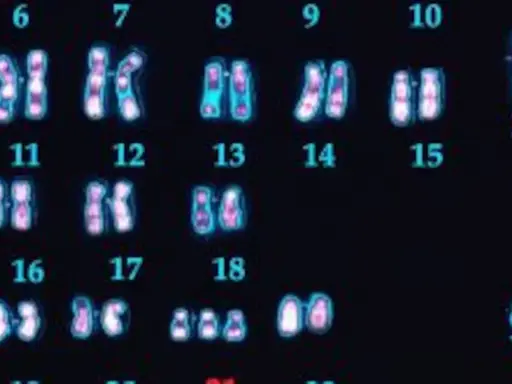 Cariotipo humano con 23 pares de cromosomas, incluyendo el par sexual X e Y. Se observan los cromosomas del 6 al 18, y el 21.