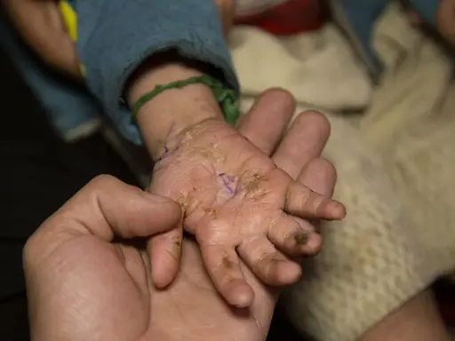 Una mano adulta sostiene la mano de un niño con piel escamosa y seca, mostrando cómo empieza la piel de mariposa.
