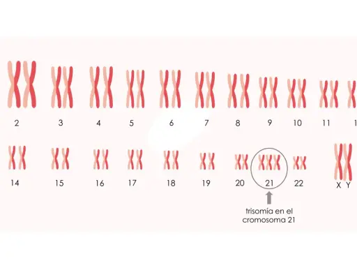 Cariotipo que muestra trisomía en el cromosoma 21, indicando cuántos cromosomas tiene un Down.