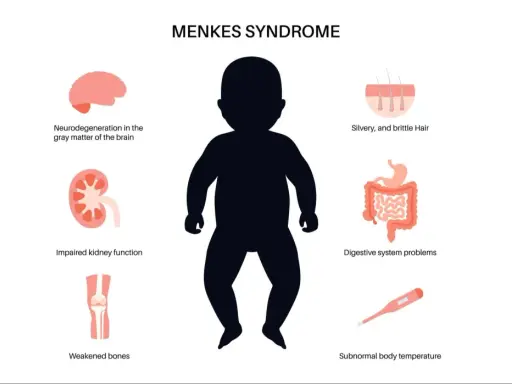 Ilustración de la enfermedad de Menkes, mostrando un bebé y sus síntomas: cabello plateado, problemas digestivos, neurodegeneración, riñones y huesos débiles, y temperatura corporal baja.