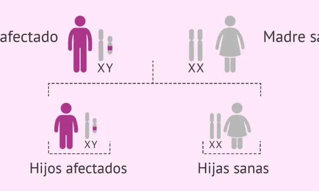 Padre afectado (XY) y madre sana (XX) tienen hijos afectados (XY) y hijas sanas (XX). El cromosoma Y determina el sexo masculino.