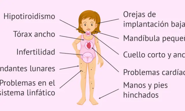Ilustración de una niña con los **síntomas del síndrome de Turner**: hipotiroidismo, tórax ancho, infertilidad, lunares, problemas linfáticos, orejas bajas, mandíbula pequeña, cuello corto, problemas cardíacos y edema.