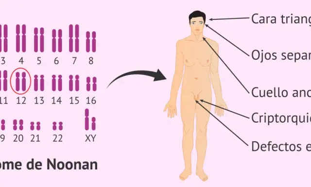 Cariotipo con anomalía en cromosoma 12, asociado a características del síndrome de Noonan: cara triangular, ojos separados, cuello ancho, criptorquidia y defectos en el pene.