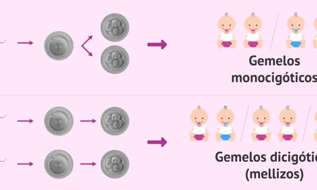 Ilustración de la concepción de gemelos. Los gemelos monocigóticos provienen de un óvulo y un espermatozoide, y pueden ser niño y niña. Los dicigóticos, de dos óvulos y dos espermatozoides.