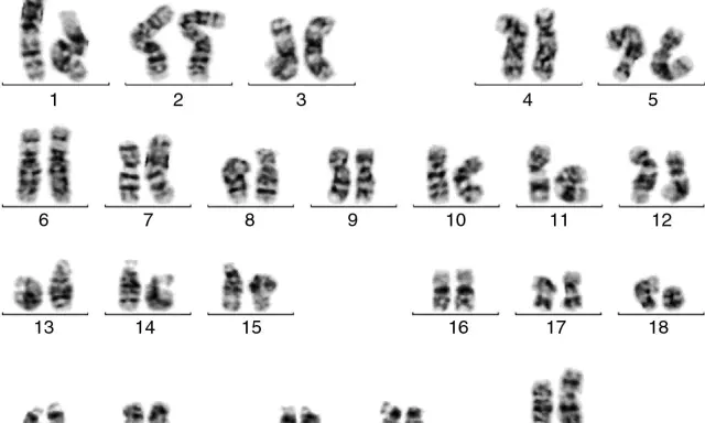 Cariotipo humano con 23 pares de cromosomas, incluyendo los autosomas del 1 al 22 y los cromosomas sexuales X e Y. Un análisis qf pcr revela la estructura de cada par.