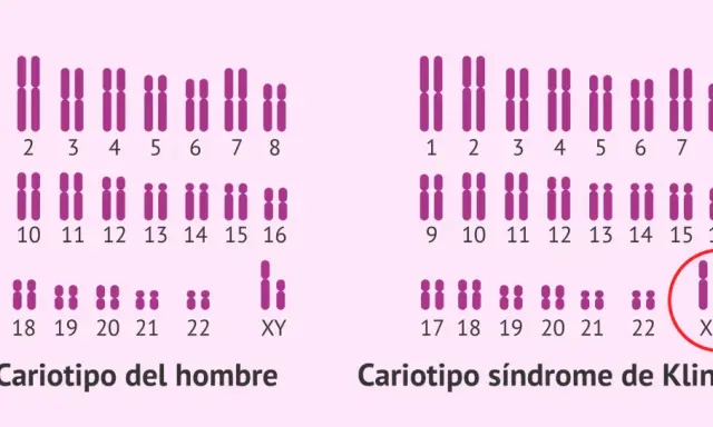 Cariotipo de hombre con cromosomas XY y cariotipo de síndrome de Klinefelter con XXY.