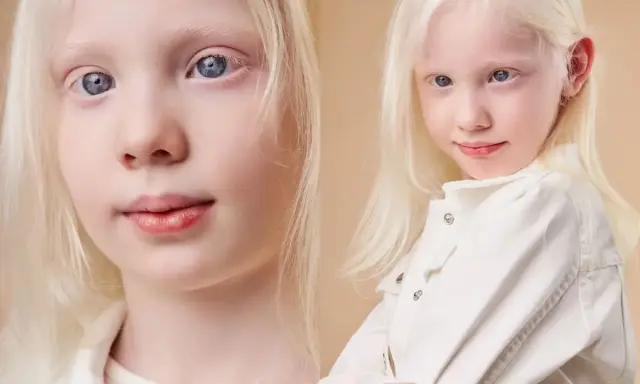 Niña con cabello rubio platino y ojos azules, una hermosa persona albina sonríe con dulzura.