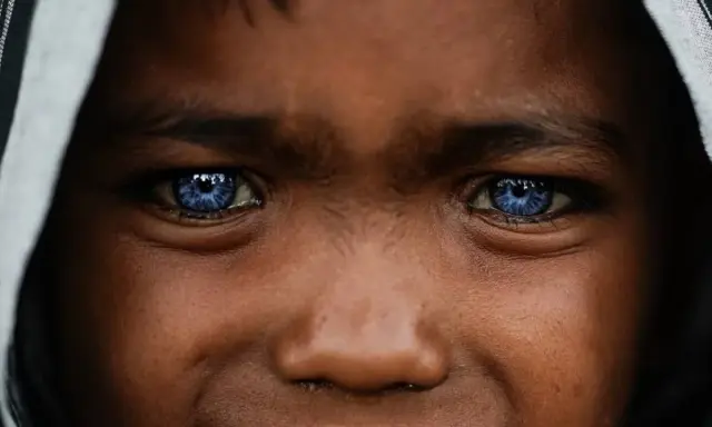 Ojos azules intensos, como el cielo, en un rostro joven. Podrían ser un rasgo distintivo del síndrome de Waardenburg, que a menudo se manifiesta con ojos de colores inusuales.