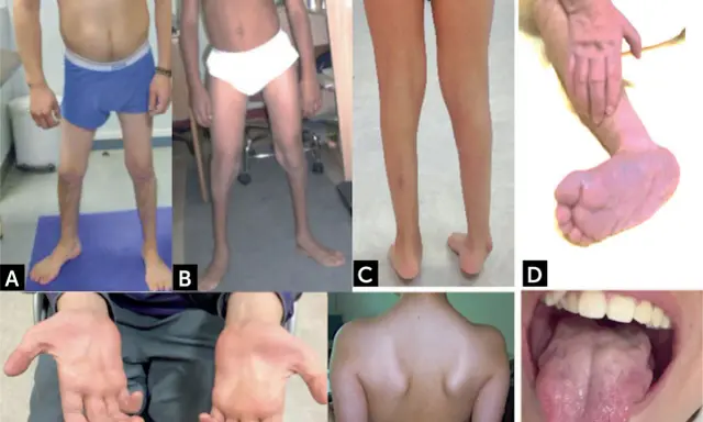 Manifestaciones de atrofia muscular espinal: piernas delgadas (A, B, C), pie equino (D), manos con dedos finos (E), espalda con escápulas prominentes (F) y lengua con fasciculaciones (G).