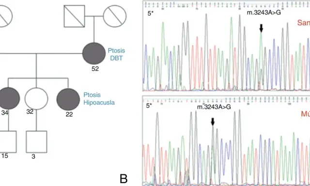 Pedigrí que muestra herencia mitocondrial de ptosis y hipoacusia, junto a electroforesis que confirma la mutación m.3243A>G.