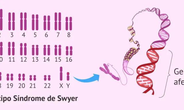 Cariotipo XY con el gen SRY afectado, indicativo del Síndrome de Swyer.