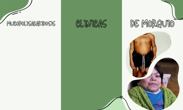 Mucopolisacaridosis: clínicas de Morquio. Imágenes de personas con esta condición.