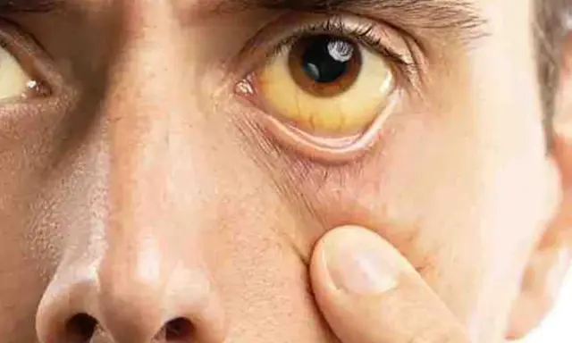 Ojo con esclerótica amarilla, indicativo de ictericia, posiblemente relacionada con sd Gilbert.