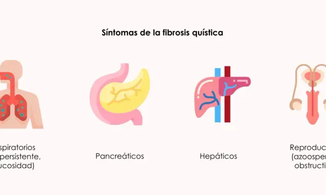Ilustración de síntomas de fibrosis quística: respiratorios (tos, mucosidad), pancreáticos, hepáticos y reproductivos (azoospermia obstructiva).