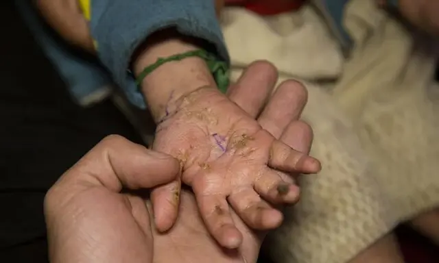 Una mano adulta sostiene la mano de un niño con piel escamosa y seca, mostrando cómo empieza la piel de mariposa.