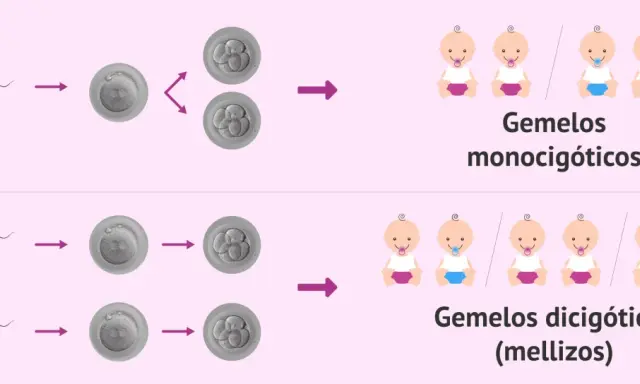 Ilustración muestra cómo un espermatozoide fecunda un óvulo, dando lugar a gemelos monocigóticos o dicigóticos. Tener gemelos depende del hombre o de la mujer.