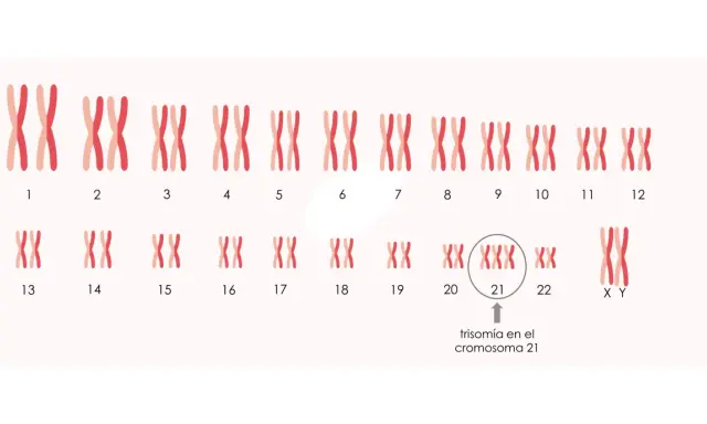 Cariotipo que muestra trisomía en el cromosoma 21, indicando cuántos cromosomas tiene un Down.