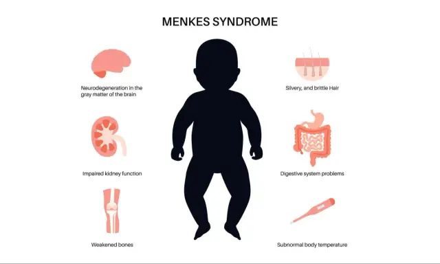 Ilustración de la enfermedad de Menkes, mostrando un bebé y sus síntomas: cabello plateado, problemas digestivos, neurodegeneración, riñones y huesos débiles, y temperatura corporal baja.
