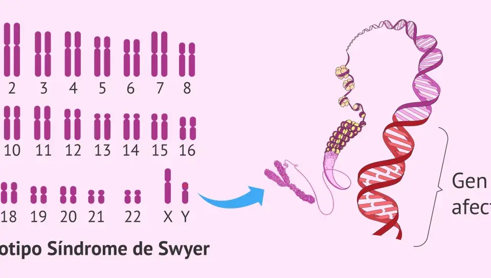 Cariotipo XY con el gen SRY afectado, indicativo del Síndrome de Swyer.