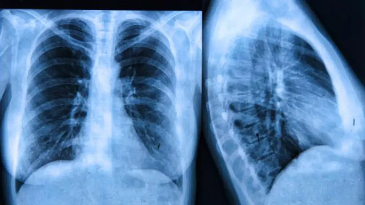 Radiograf&iacute;as de t&oacute;rax, frontal y lateral, mostrando posibles signos de fibrosis qu&iacute;stica.