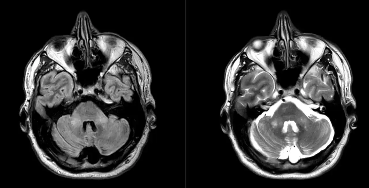 Cortes axiales de resonancia magn&eacute;tica cerebral que muestran atrofia cerebelosa, indicativa de ataxia espinocerebelosa.