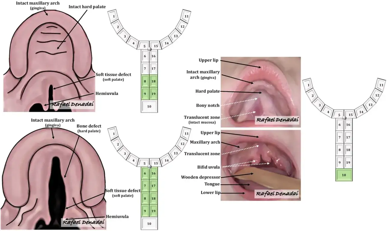 Ilustración y fotos de un bebé con un agujero en el paladar, mostrando la anatomía y defectos.