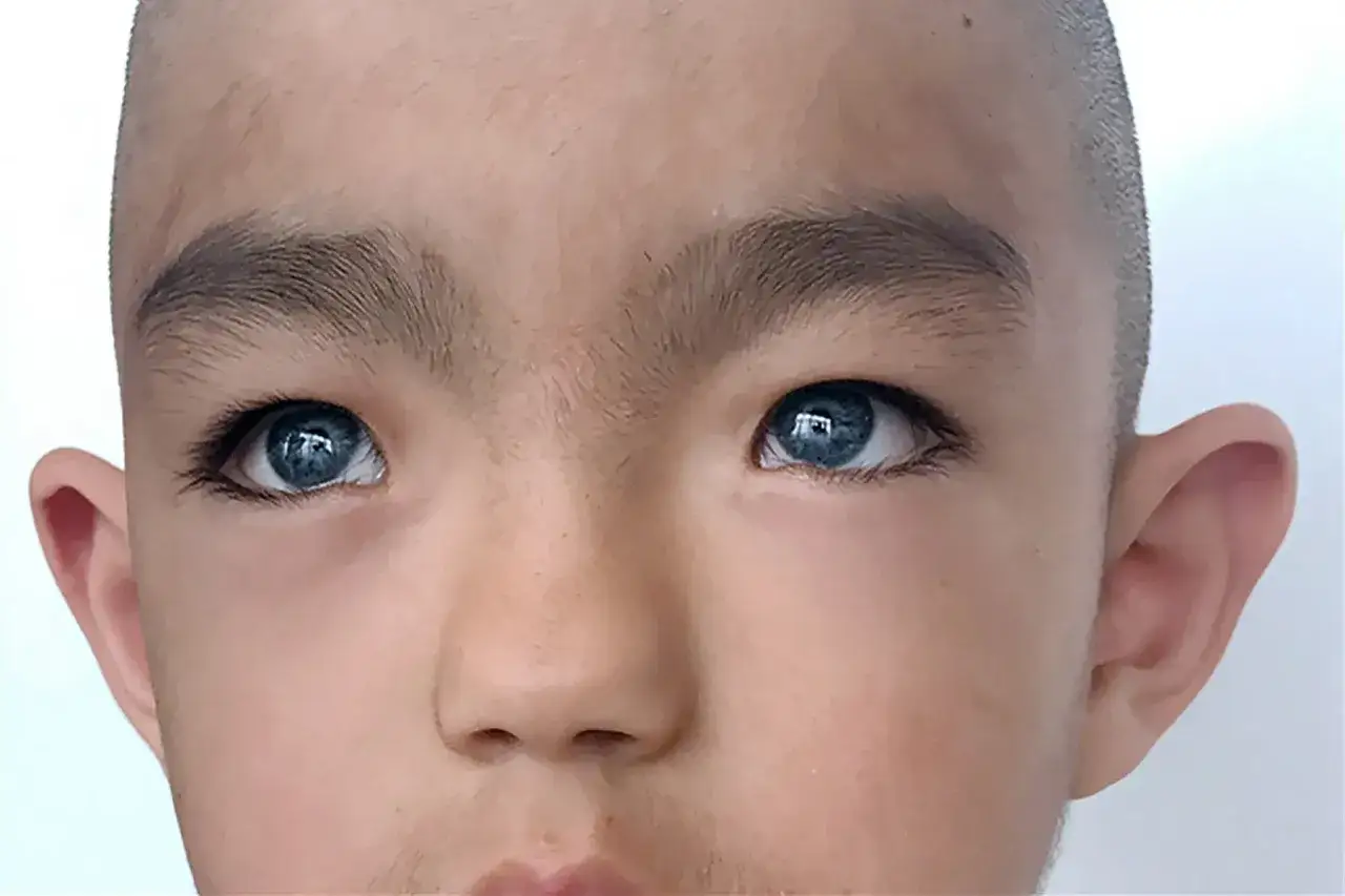 Ojos azules intensos, característicos del síndrome de Waardenburg, en un niño con cabello rapado y orejas prominentes.