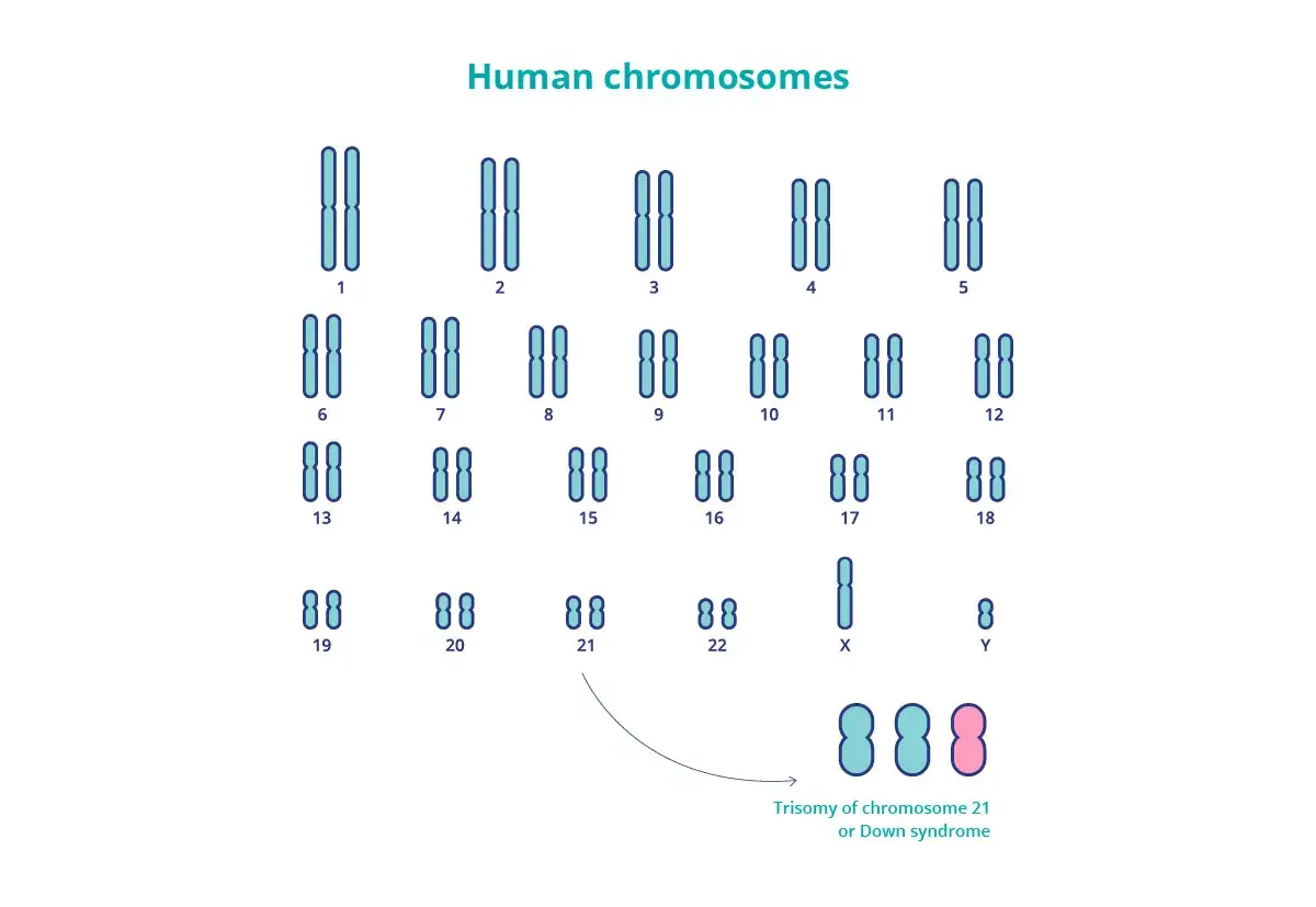 Cariotipo humano que muestra la trisom&iacute;a del cromosoma 21, causa de la enfermedad de Down.