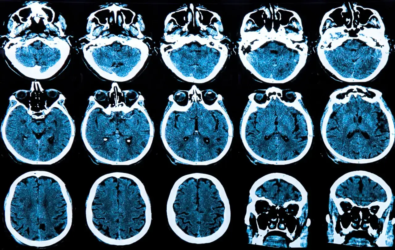 Cortes cerebrales en tomografía, mostrando la complejidad del cerebro. La investigación sobre la enfermedad de Huntington y sus causas genéticas es crucial.