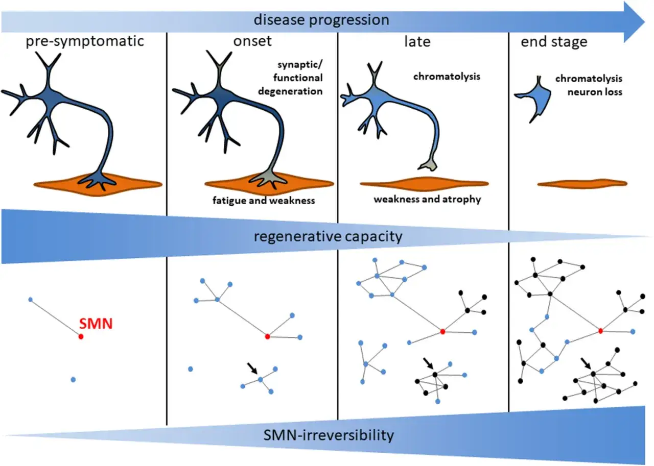 Ilustraci&oacute;n de la progresi&oacute;n de la atrofia muscular espinal, mostrando degeneraci&oacute;n neuronal y p&eacute;rdida de capacidad regenerativa.