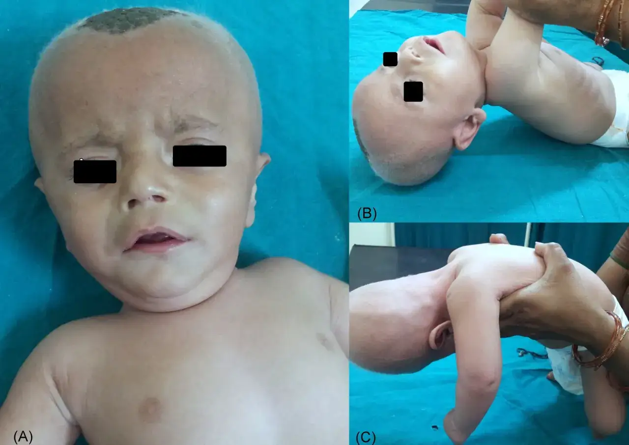 Bebé con rasgos faciales característicos de la enfermedad de Menkes, incluyendo piel fina y cabello escaso. Las imágenes (B) y (C) muestran hipotonia.